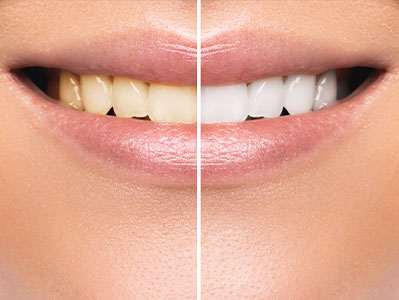 A before-and-after comparison of a person's teeth, highlighting the difference between uncleaned and professionally cleaned teeth.
