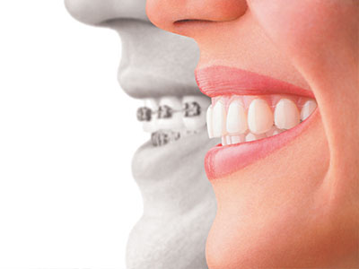 The image is a composite of two photographs one shows a smiling woman with straight teeth, and the other is an inset photo of a man s face obscured by a large, transparent mouthpiece, which appears to be a dental appliance.