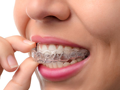 The image shows a person holding a clear aligner with their teeth, focusing on the device while it is in place.